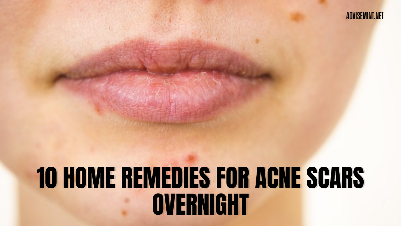 10 Home Remedies For Acne Scars Overnight