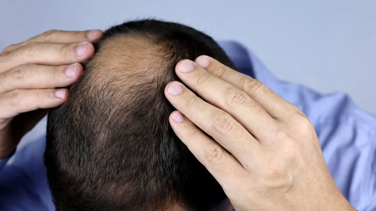 Smart Investments – Choosing the Right Clinic Matters for Hair Transplants